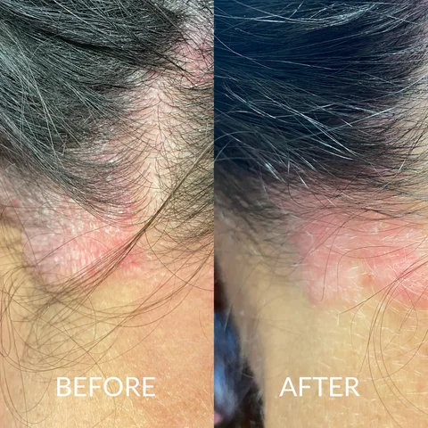woman with psoriasis on her scalp
